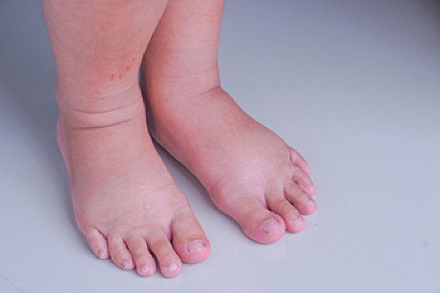 Why Diabetes Makes Your Feet Swell